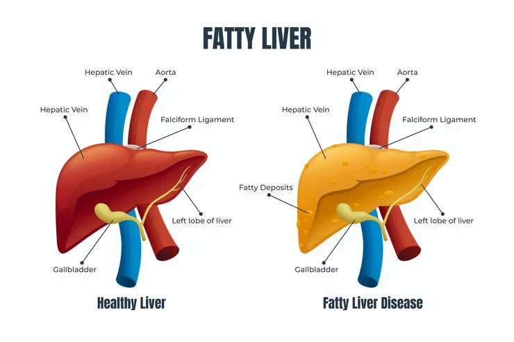 All You Need to Know about Fatty Liver Disease - Blog Image