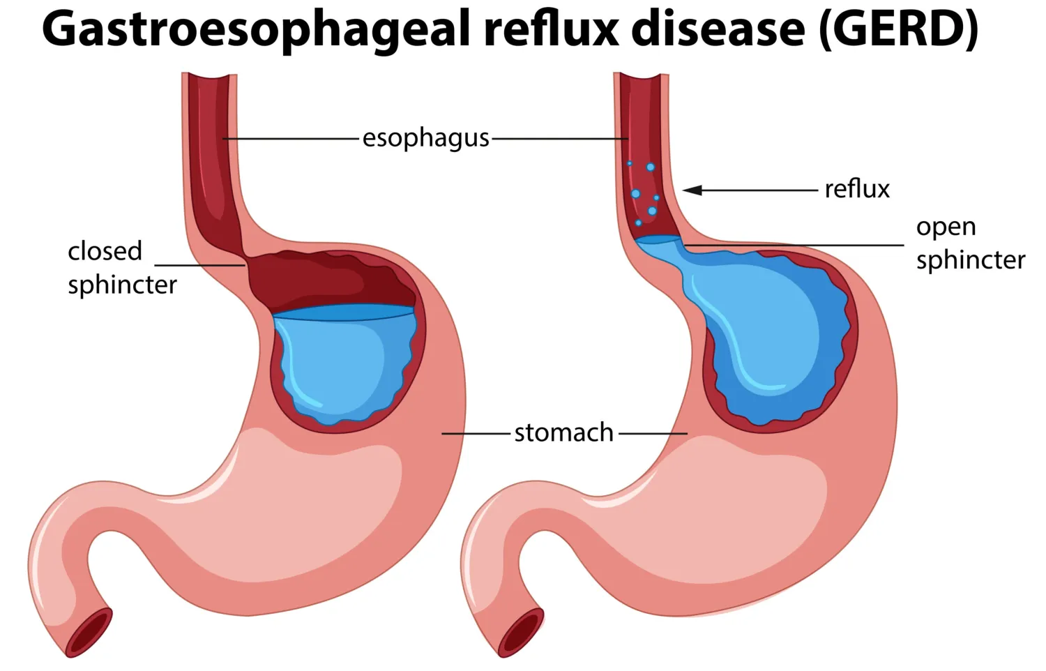 What Should You Know About Acid Reflux (GERD)? - Blog Image