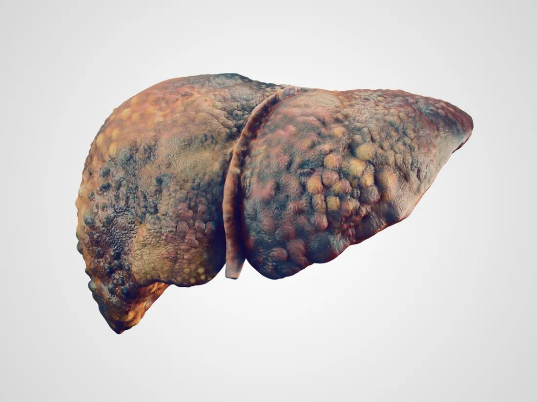 Alcoholic Liver Disease And How it’s Treated - Blog Image