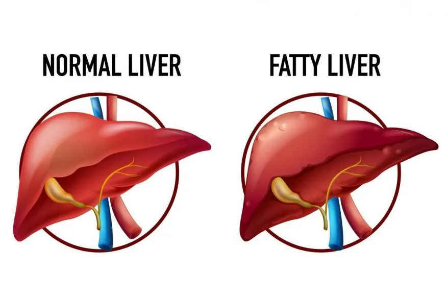 Best Hepatologist in Faridabad explains the Fatty Liver Disease