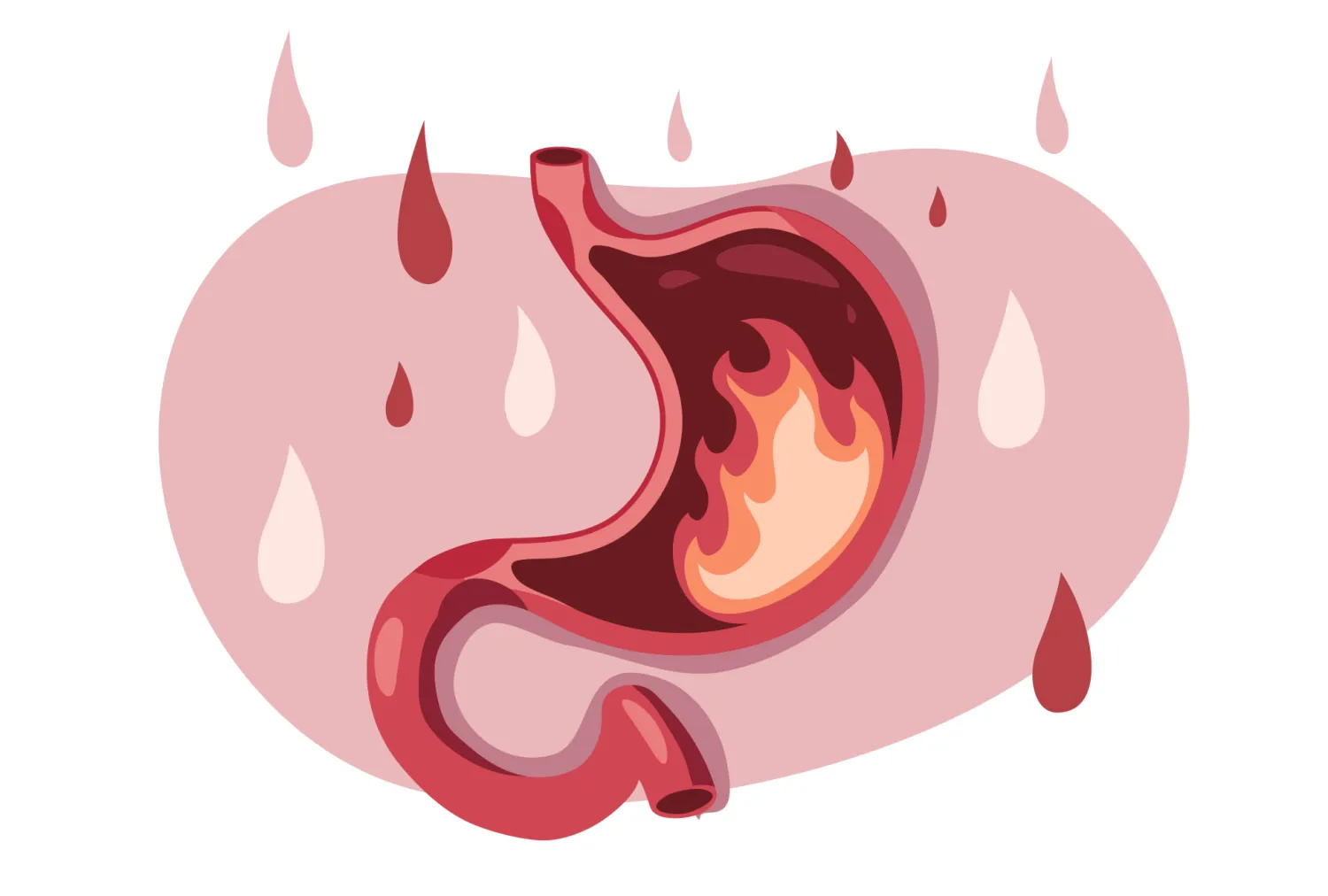Foods to Eat and Avoid with GERD and Acid Reflux - Blog Image