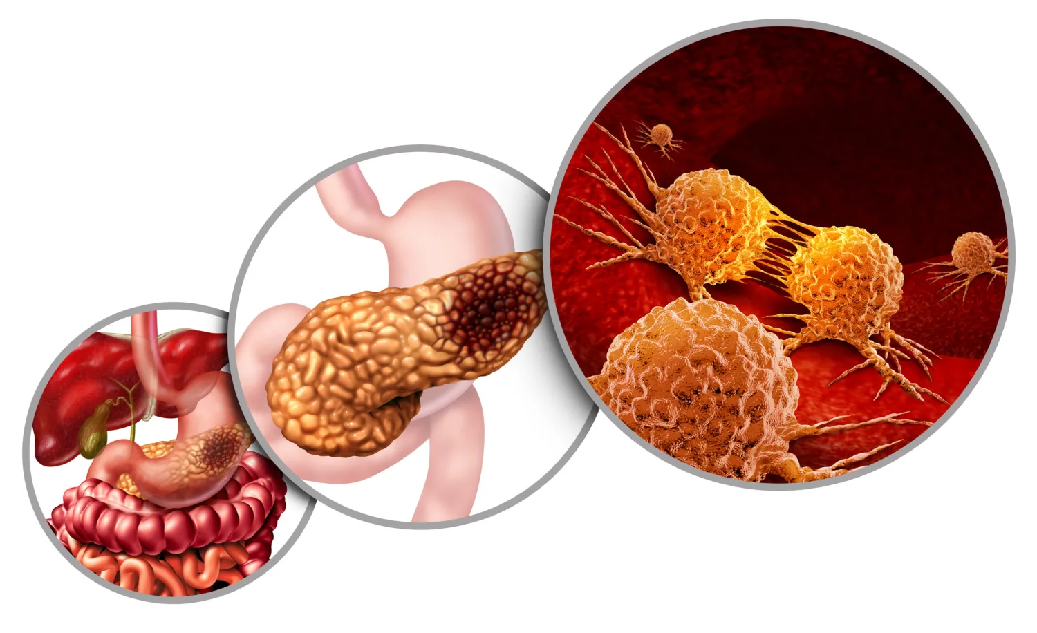 Pancreatic Cancer: Symptoms, Causes and Treatment - Blog Image