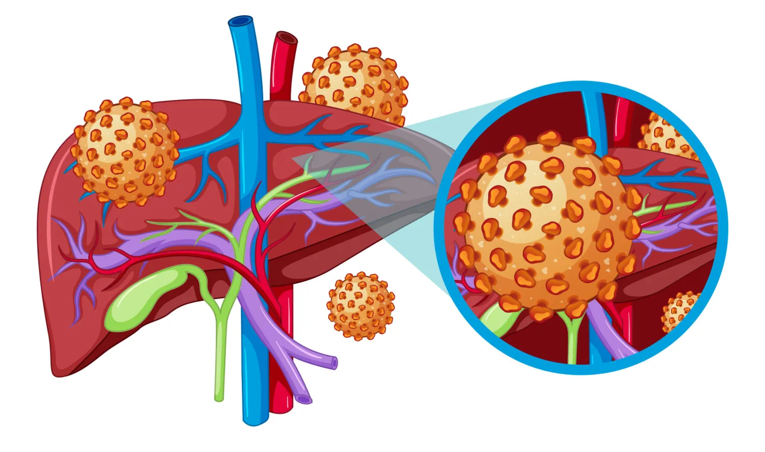 Hepatitis A – Causes, Symptoms, Treatment and Prevention - Blog Image