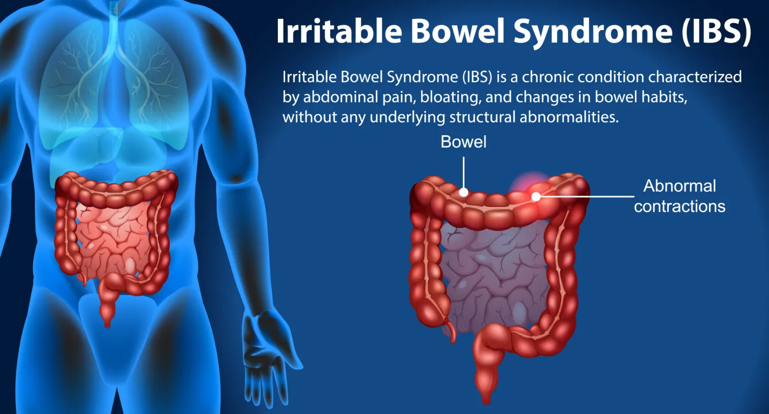 Irritable Bowel Syndrome (IBS): Causes, Symptoms, and Management - Blog Image