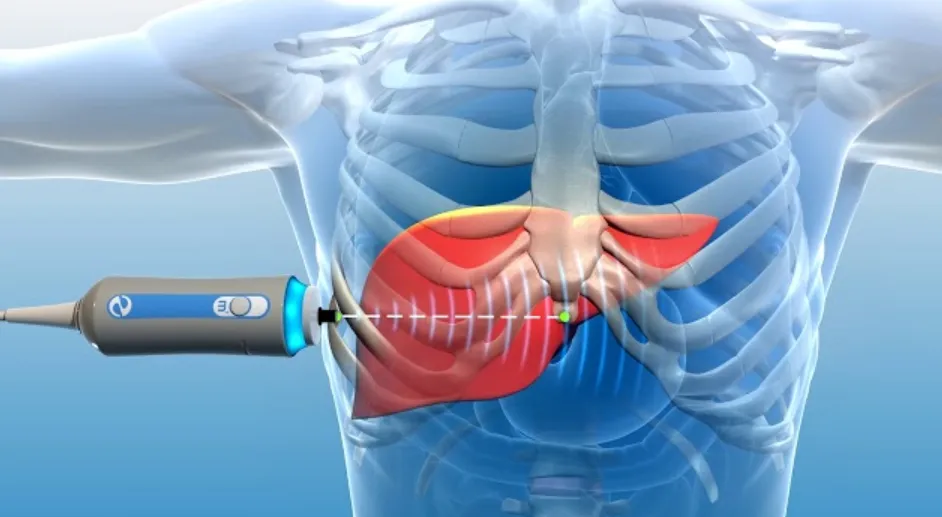 Fibroscan Doctor in Faridabad – Dr. Ram C Soni - Blog Image