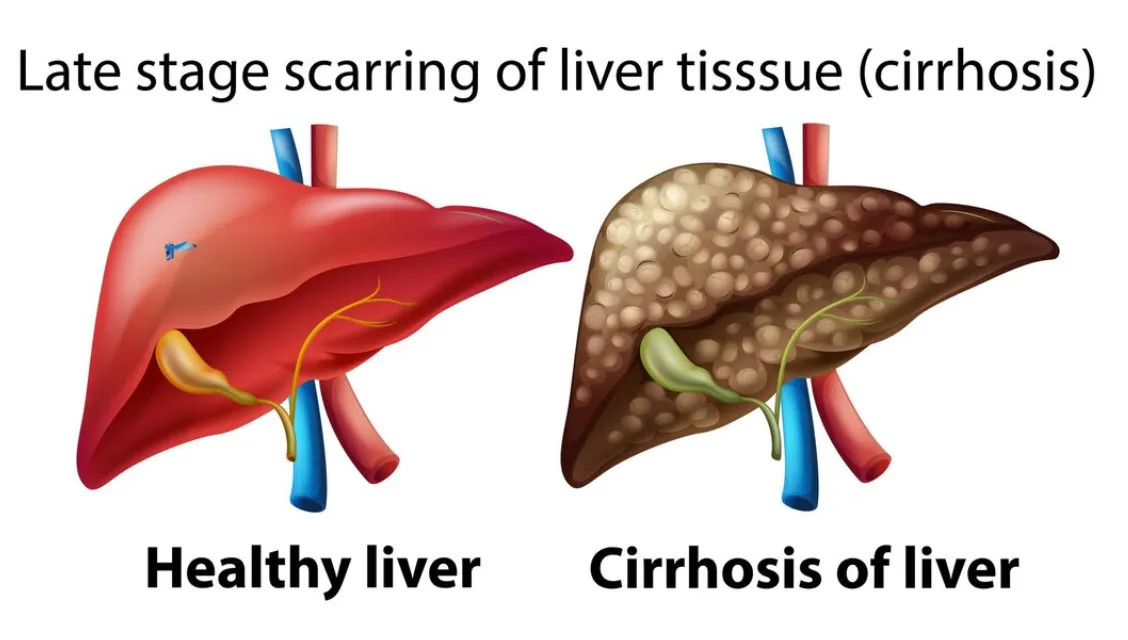 What is Cirrhosis of The Liver: Cause, Diagnosed and Treatment - Blog Image