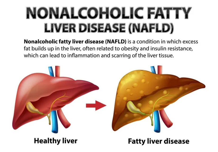 Non-Alcoholic Fatty Liver Disease (NAFLD): An Overview - Blog Image