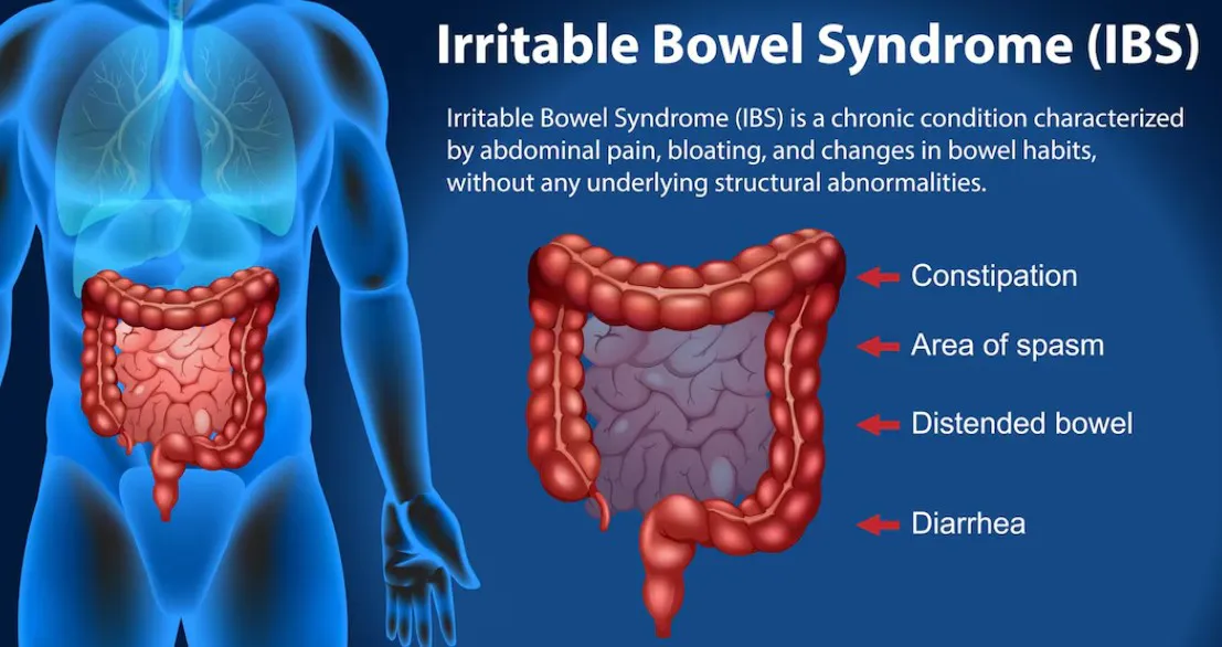 Managing IBS (Irritable Bowel Syndrome): Effective Treatment Options in Faridabad - Blog Image