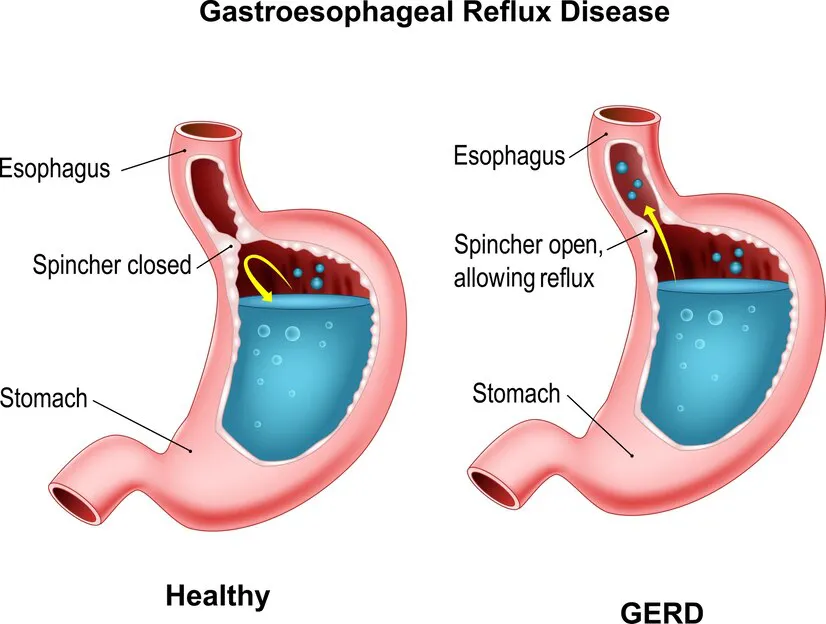 GERD Myths Debunked: Separating Fact from Fiction with Dr. RC Soni - Blog Image