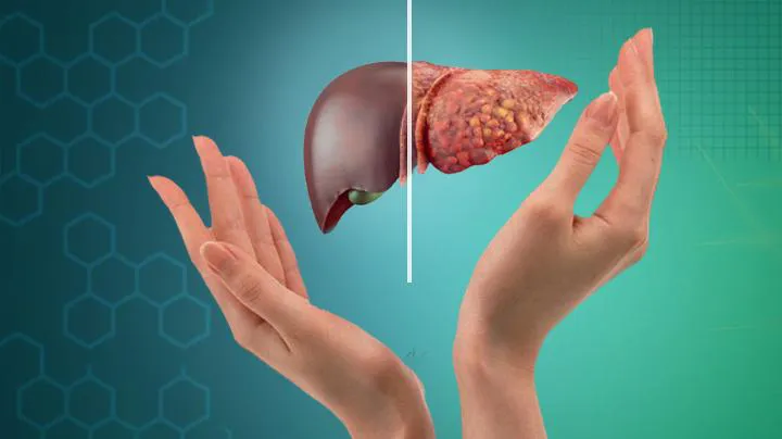 Fatty Liver Disease: Causes, Symptoms & How a Gastroenterologist Can Help - Blog Image