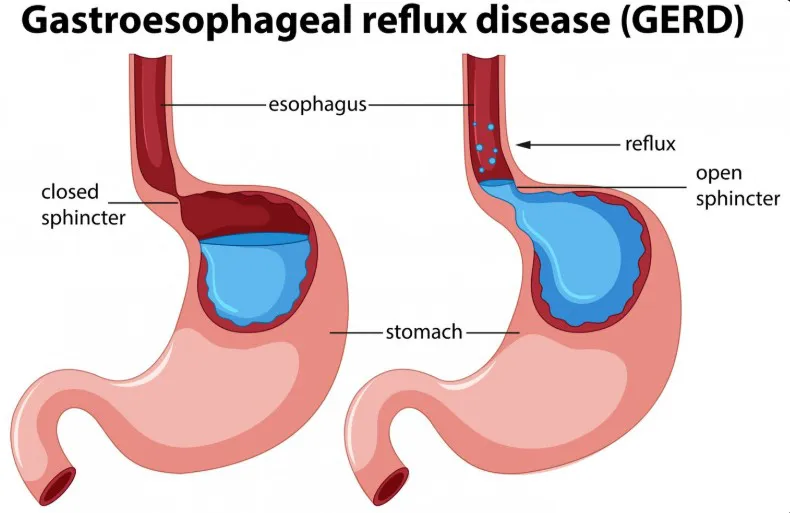 Understanding GERD: A Comprehensive Guide - Blog Image