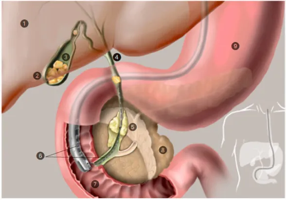 ERCP
