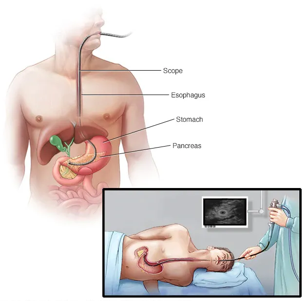 Endoscopic Ultrasound
