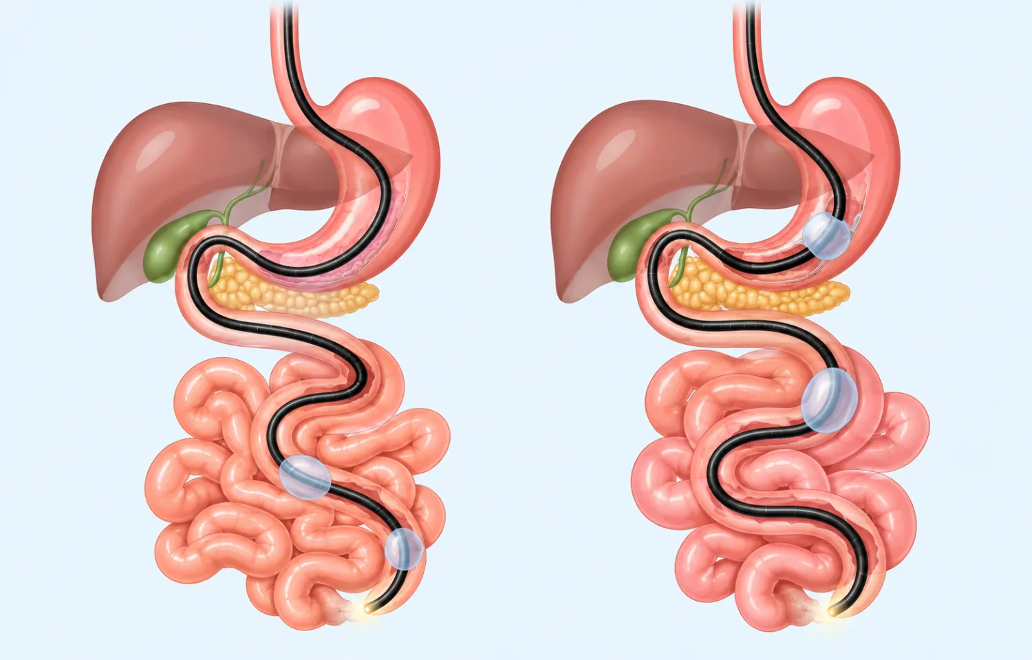 Enteroscopy