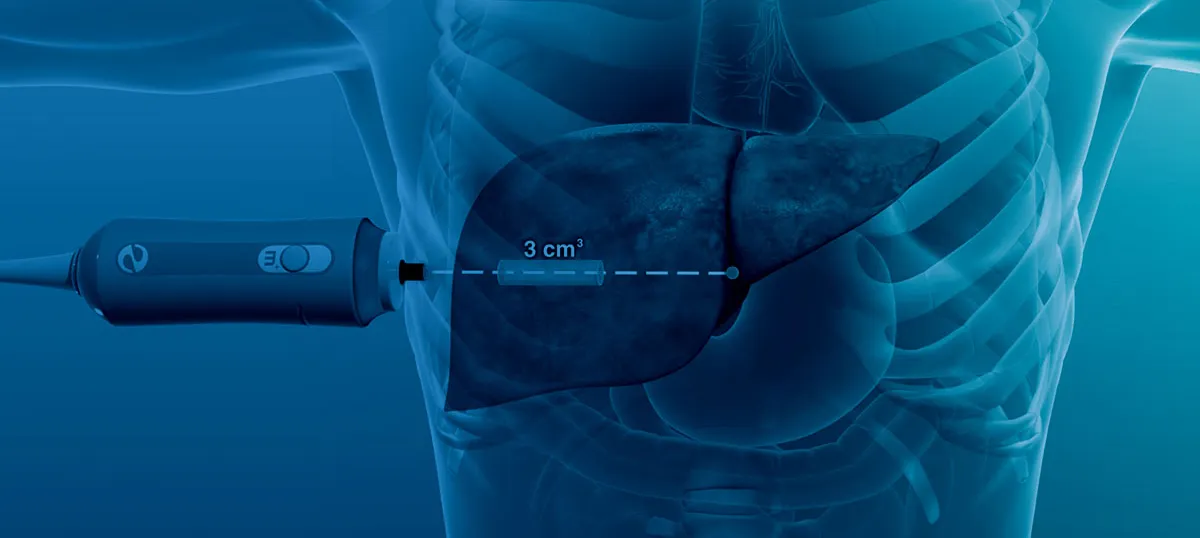 FibroScan