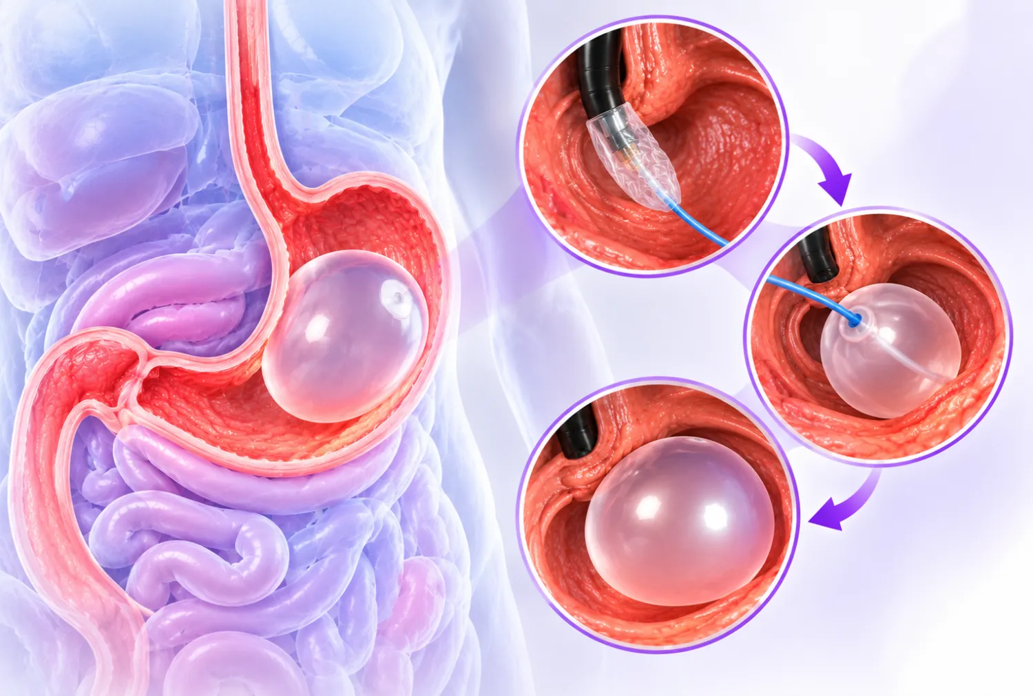 Intragastric Balloon Placement                    </div>
                
                <div class=