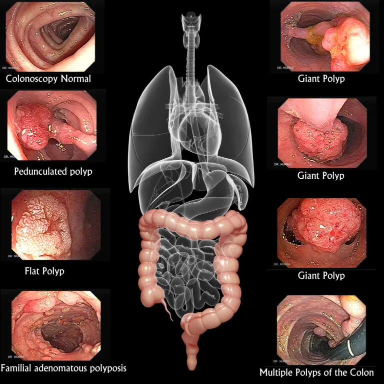 Colonic Polyps & Cancer