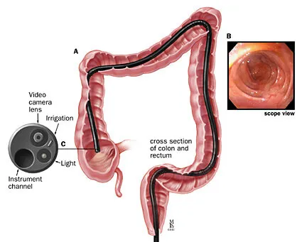 Colonoscopy
