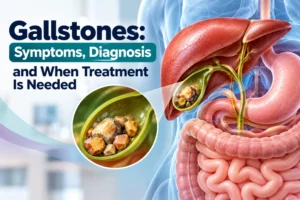 Gallstones: Symptoms, Diagnosis and When Treatment Is Needed
